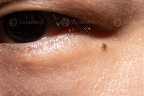do moles have eyes|moles under eyes.